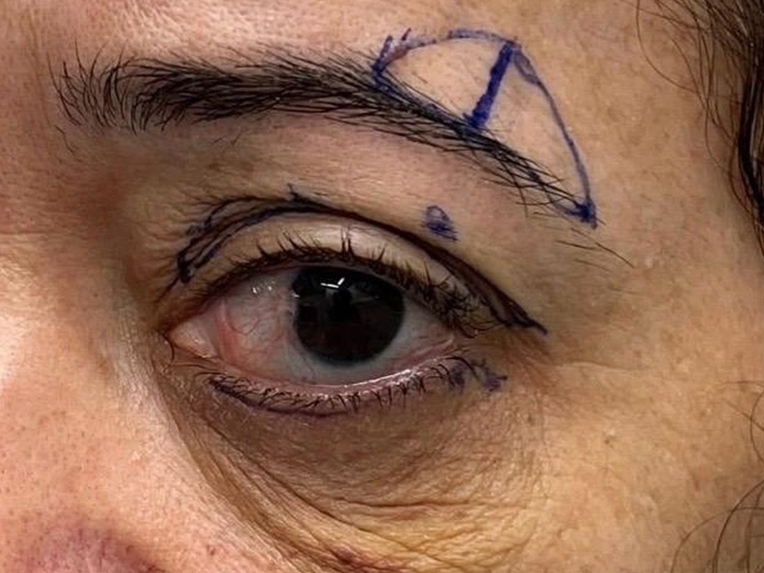 Olhar da paciente antes do rejuvenescimento, com a marcação cirúrgica
