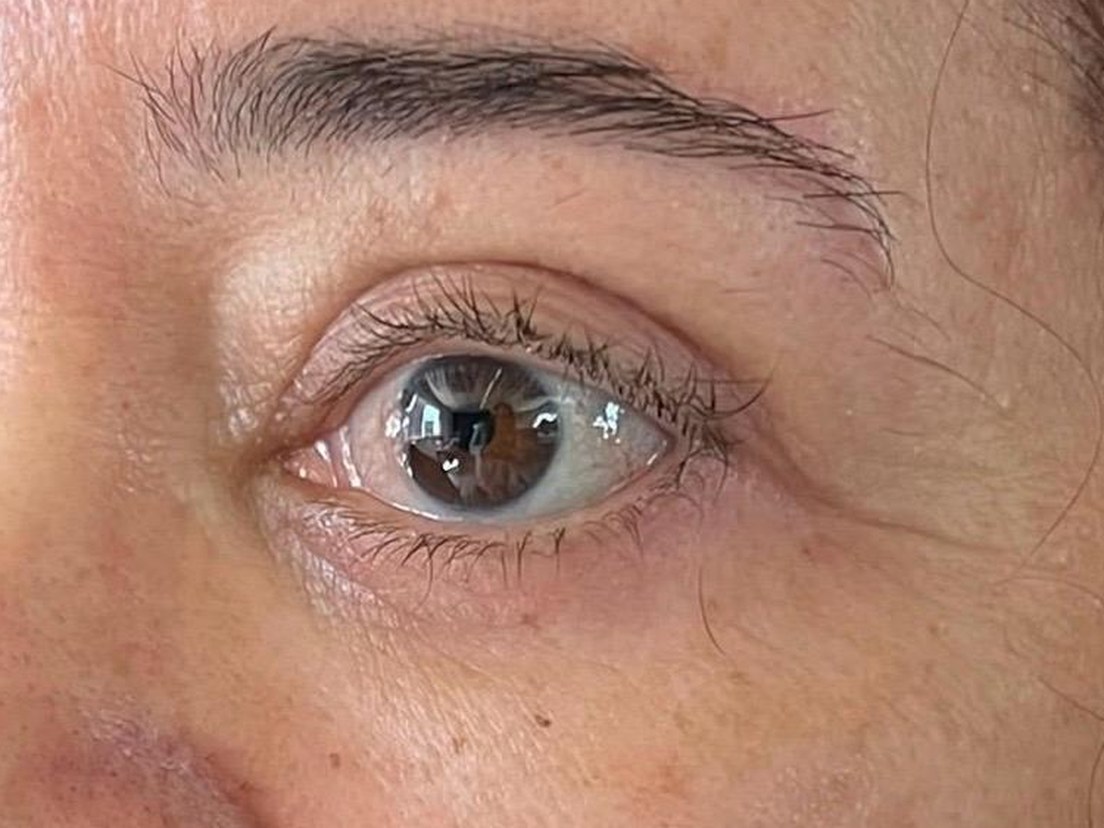 Olhar da paciente depois do rejuvenescimento